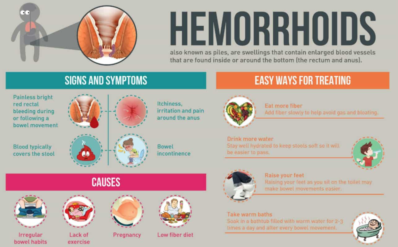 Hemorrhoids during pregnancy